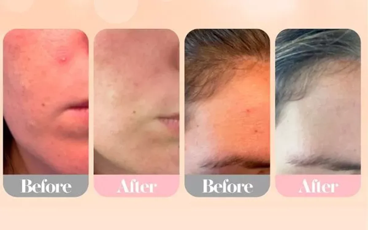old toothpaste bathroom shelf acne remedy